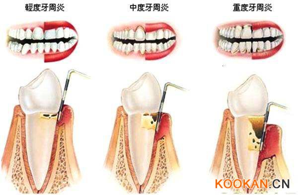 牙周炎的三個階段