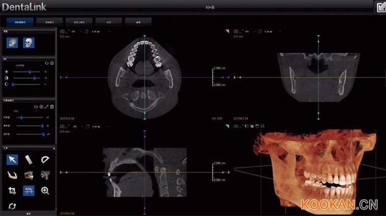 牙醫(yī)管家CBCT軟件界面