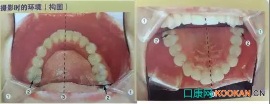 拍不好口腔照片怎么辦？這些口腔攝影方法與技巧請收好！